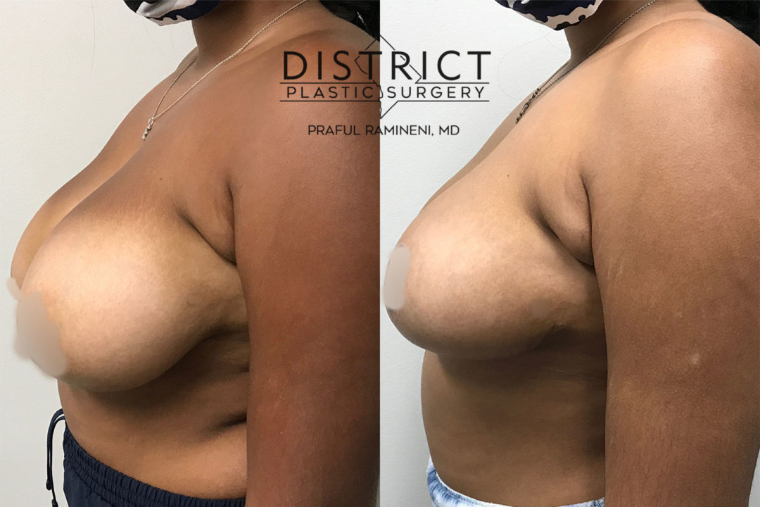 breast reduction before and after