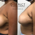 breast reduction before and after