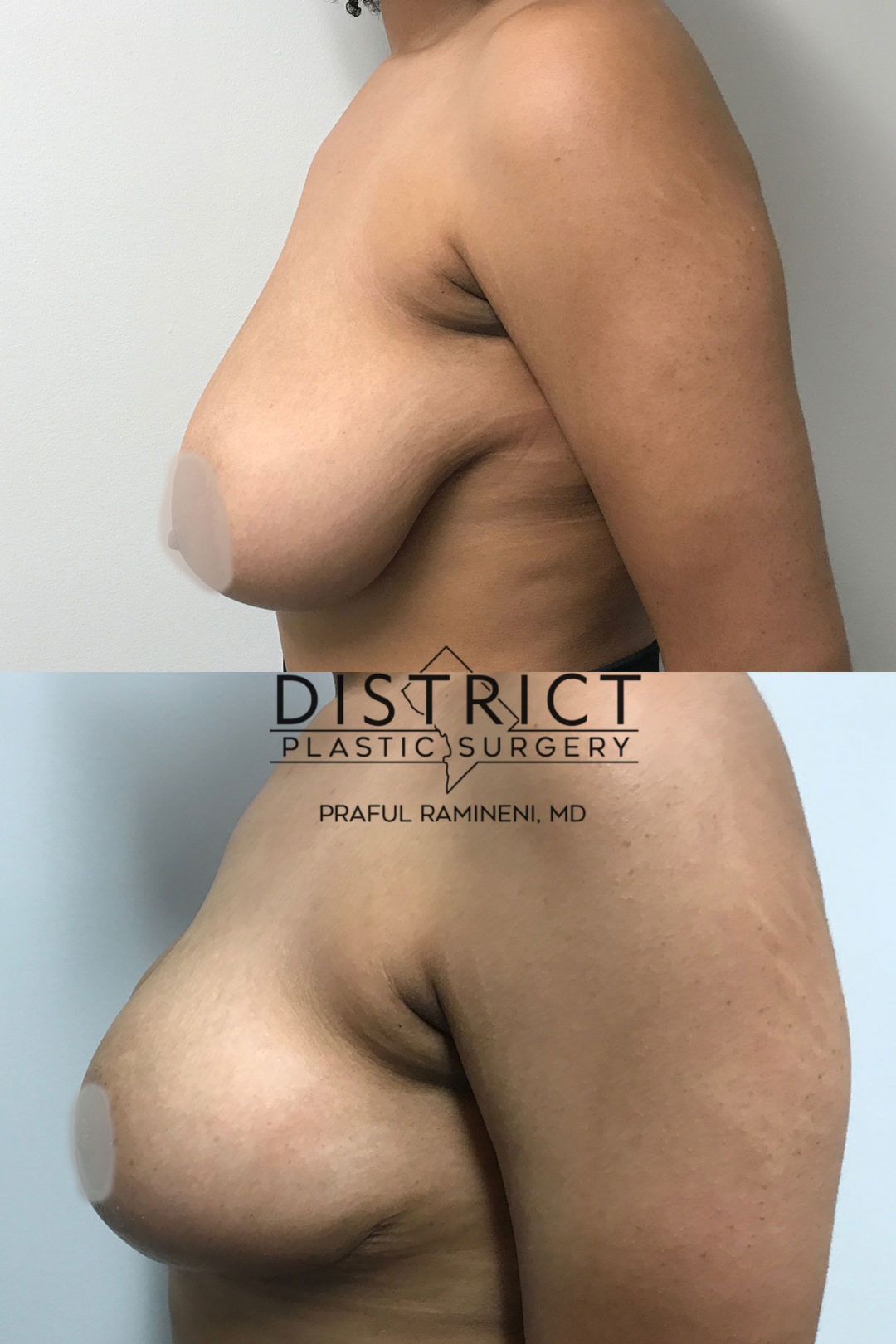 breast reduction before and after