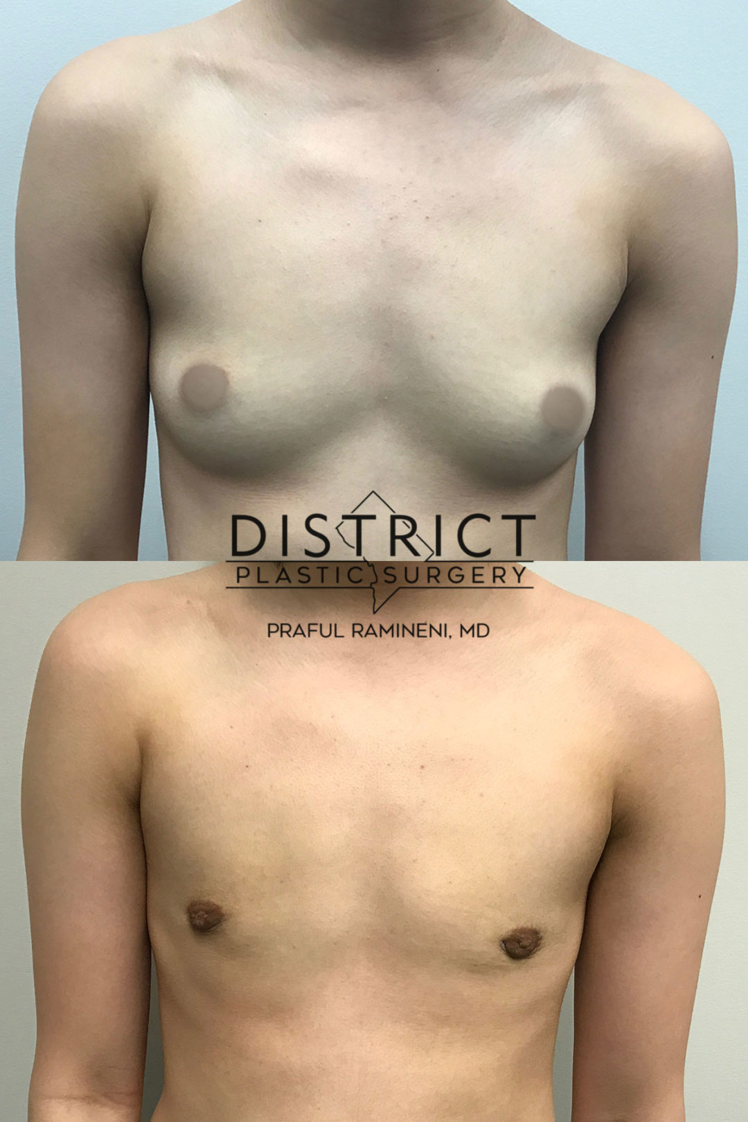 peri-areolar mastectomy before and after