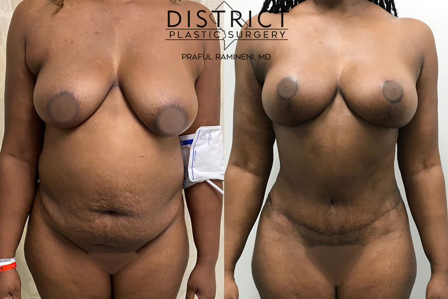 Tummy Tuck Before & After