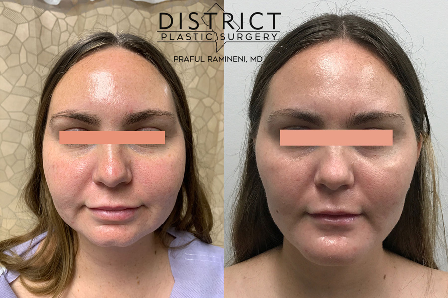 Buccal Fat Removal Before & after