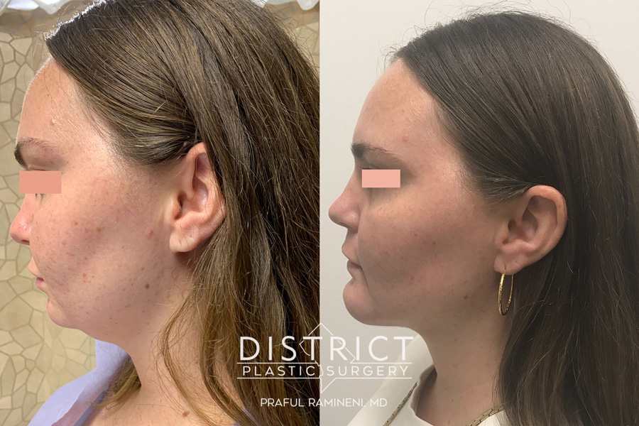chin augmentation before & after