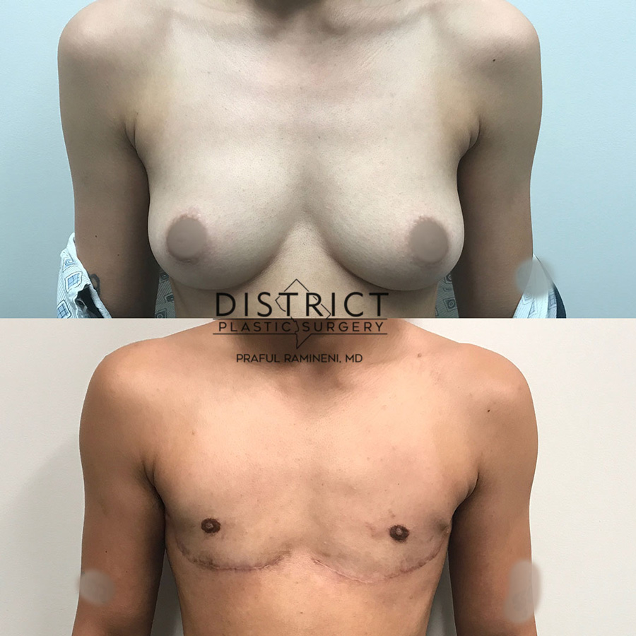 Double Incision Mastectomy Before & After