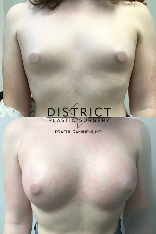 Male to Female Breast-Augmentation Before & After