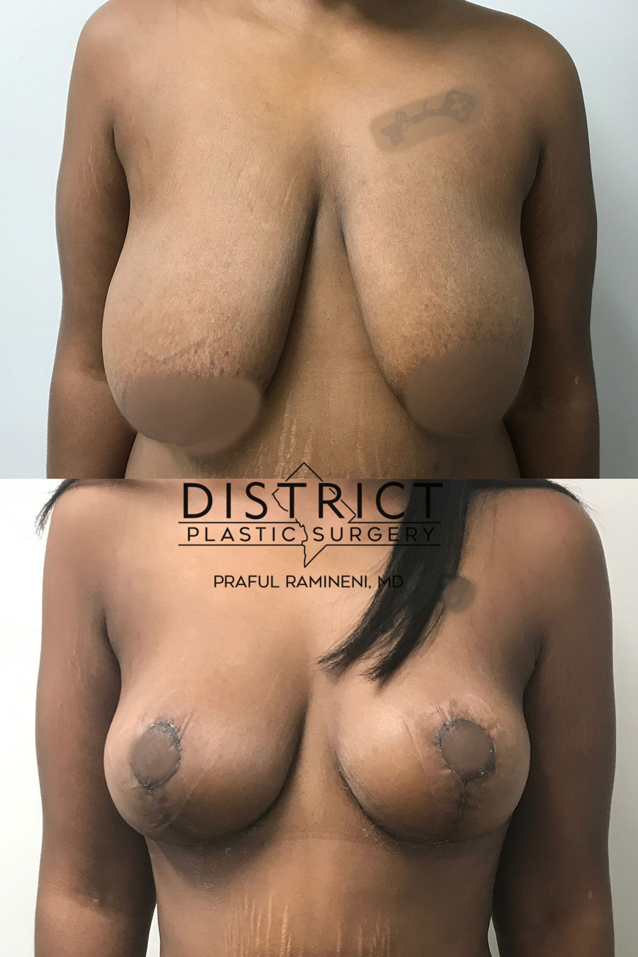 breast lift without surgery