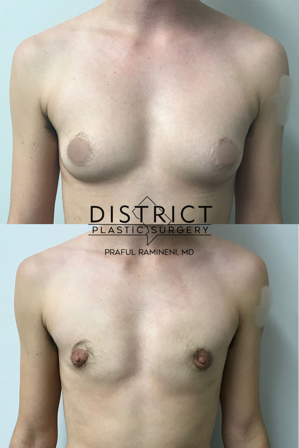 periareolar mastectomy before & after