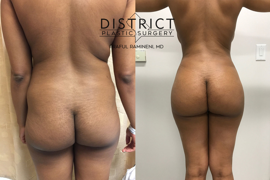 brazilian butt lift before & after