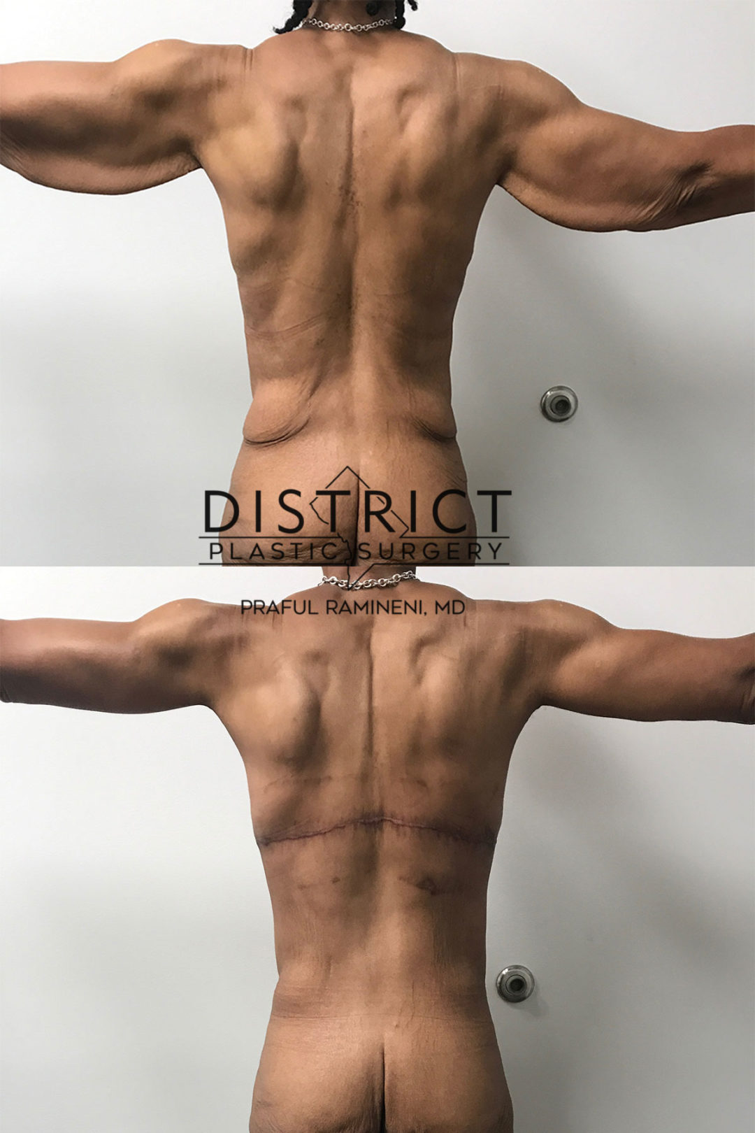arm lift before and after