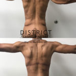 arm lift before and after