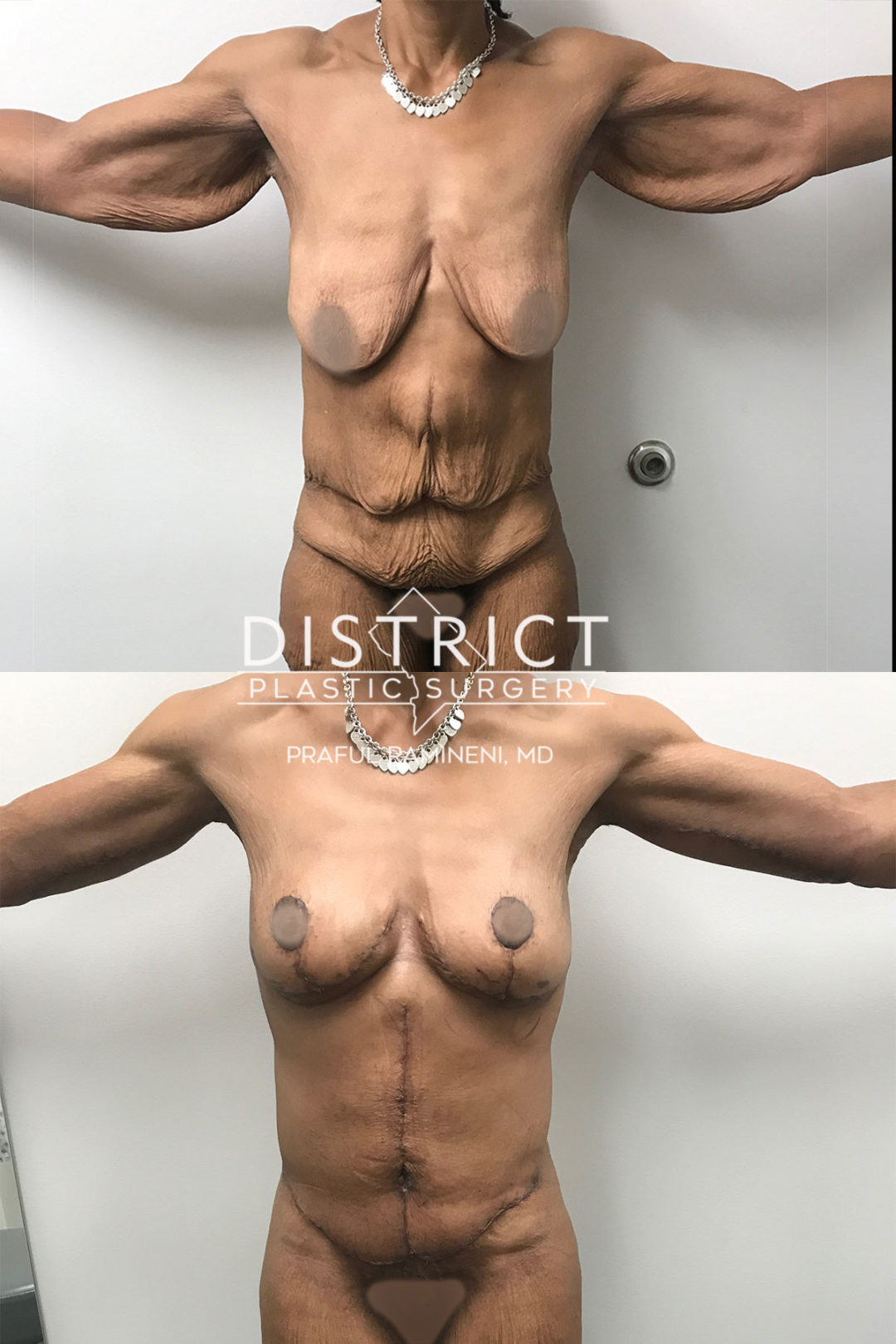 arm lift before and after