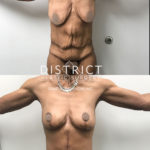 arm lift before and after