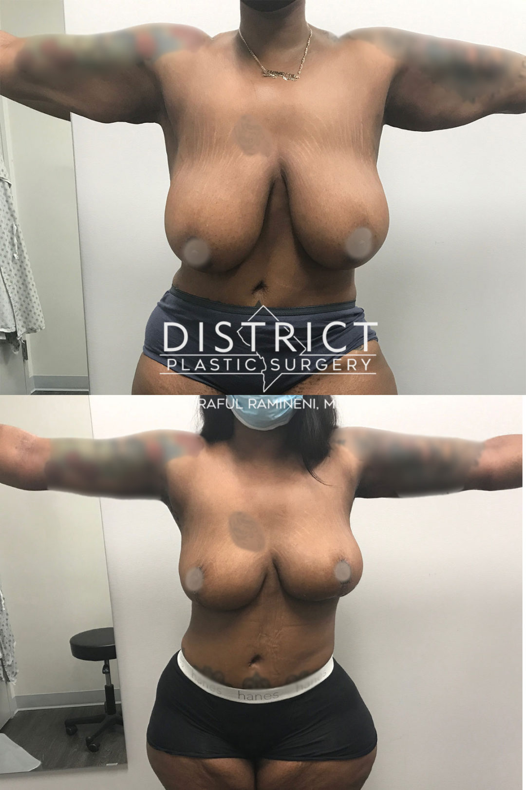 arm lift before and after