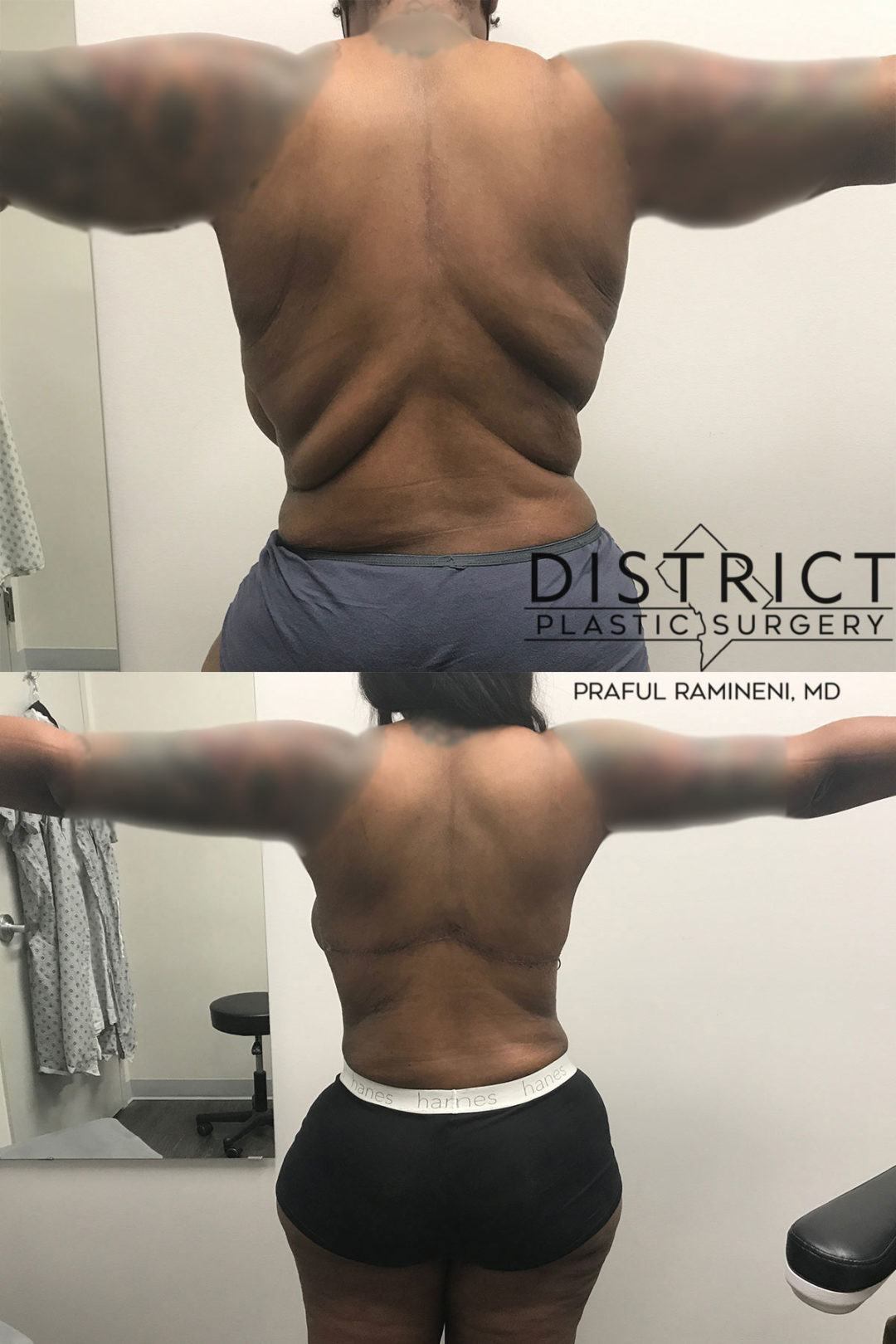 back lift before and after