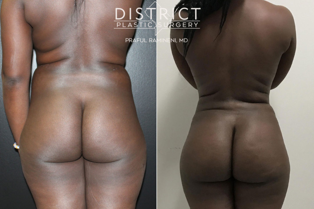 brazillian butt lift before and after