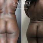 brazillian butt lift before and after