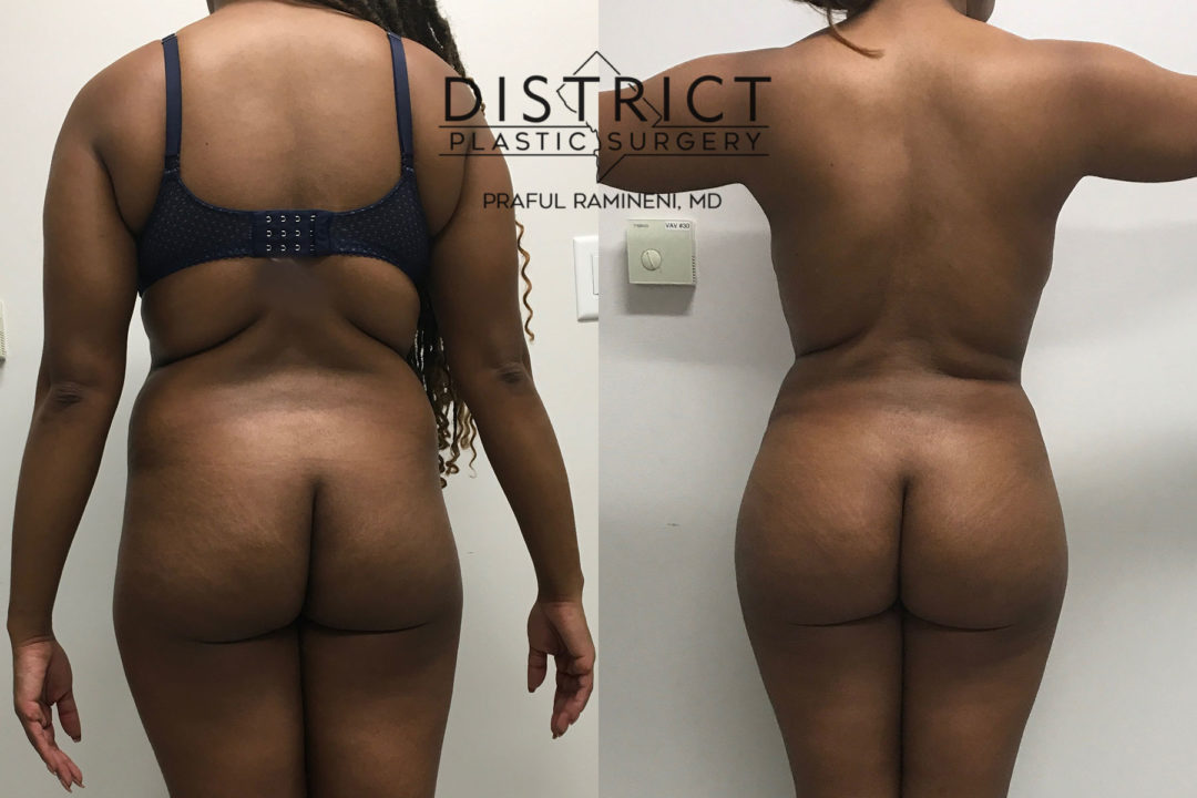 brazillian butt lift before and after