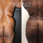 brazillian butt lift before and after