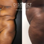 brazillian butt lift before and after