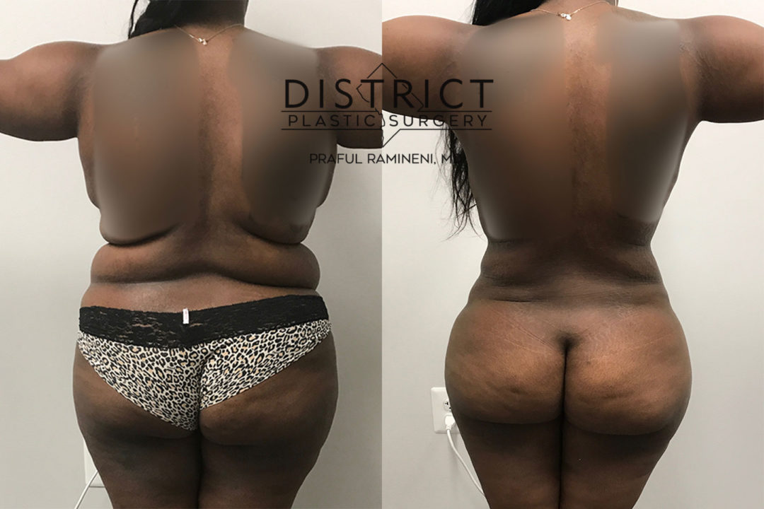 brazillian butt lift before and after
