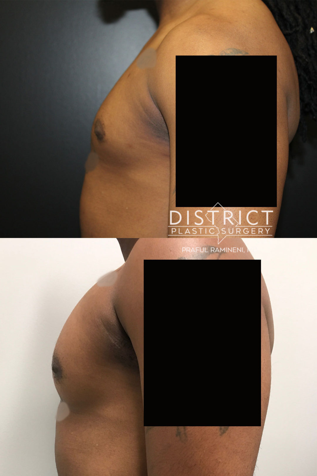 body implants before and after