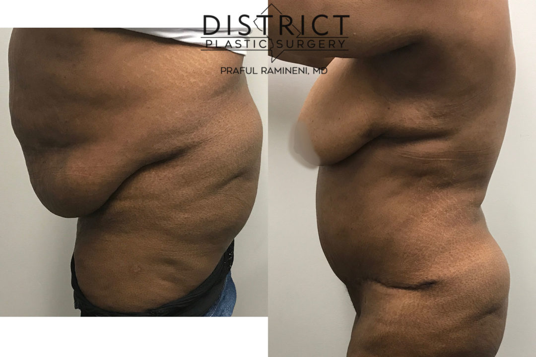 abdominoplasty before and after
