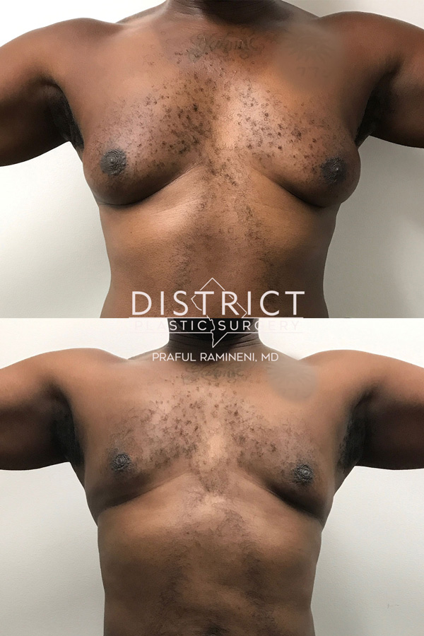 gynecosmatia surgery before and after
