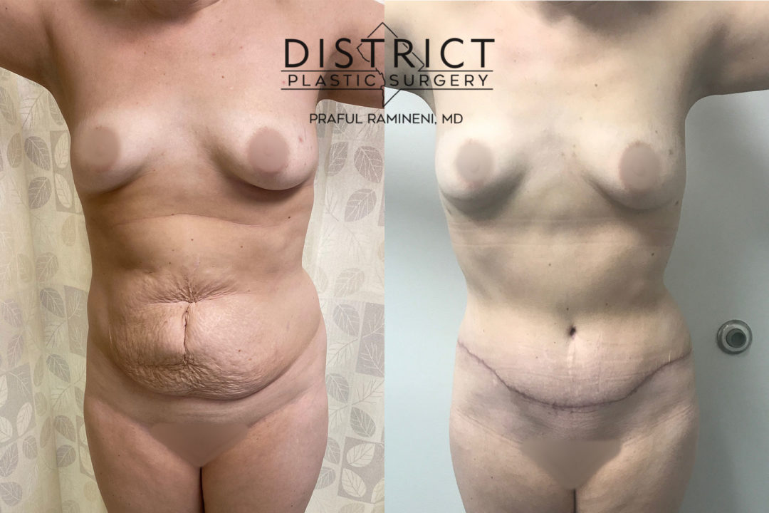 abdominoplasty before and after