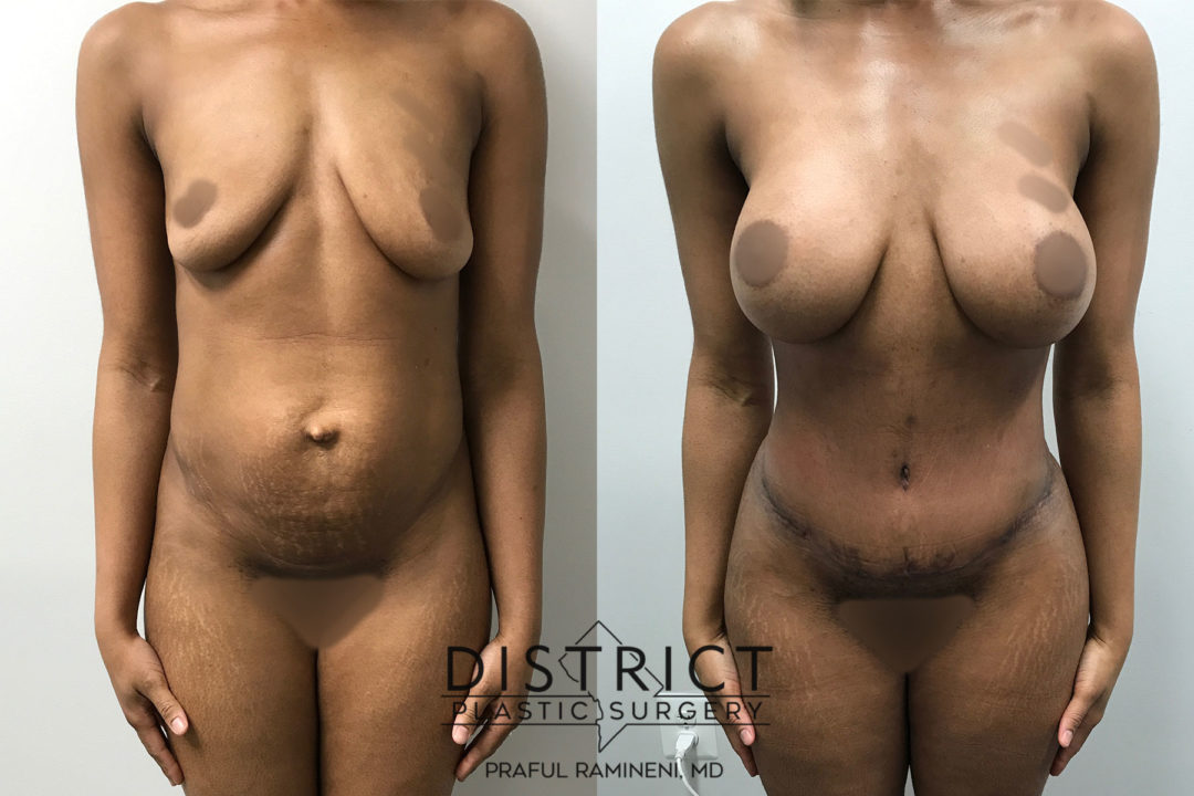 abdominoplasty before and after