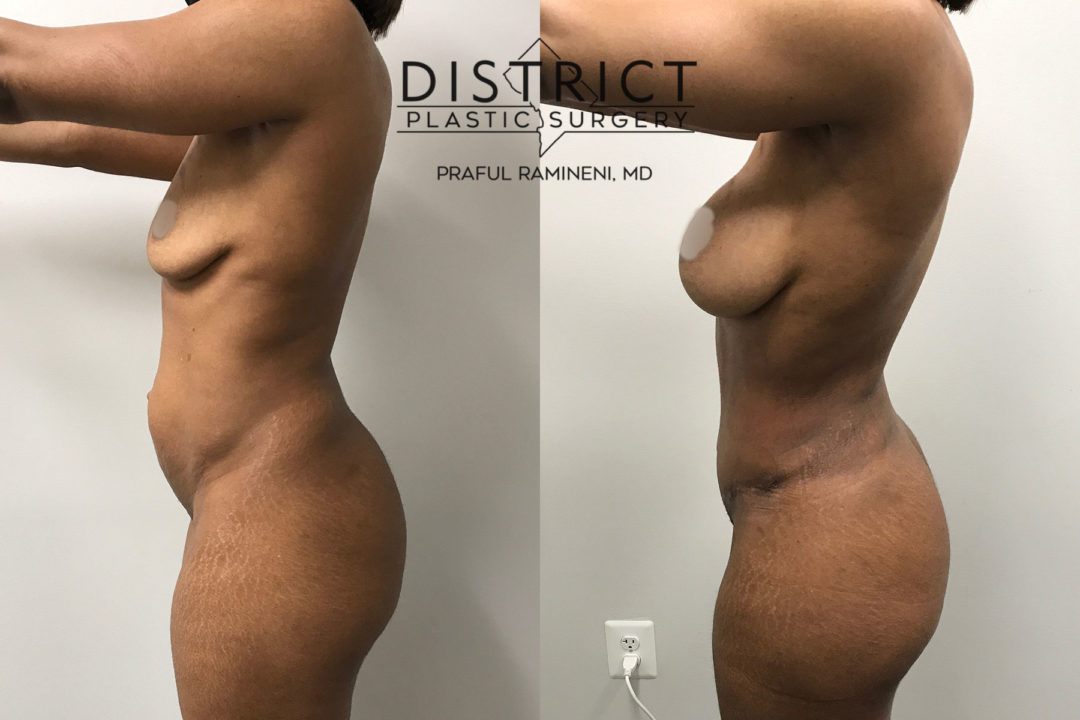 abdominoplasty before and after