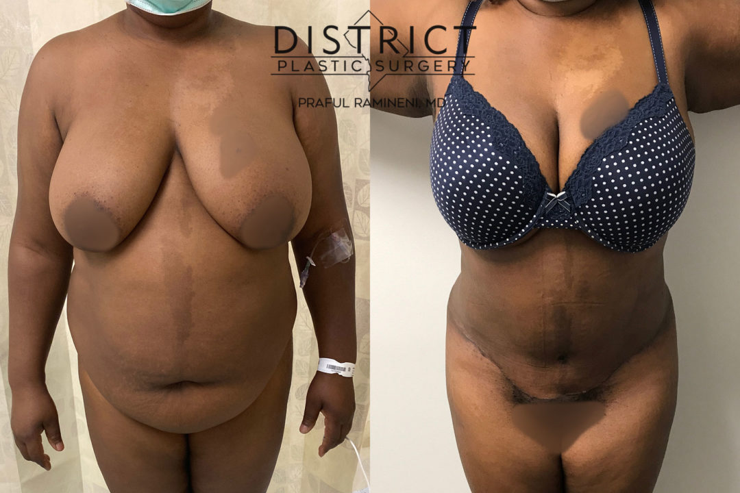 abdominoplasty before and after
