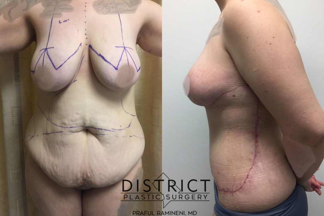 mommy makeover before and after