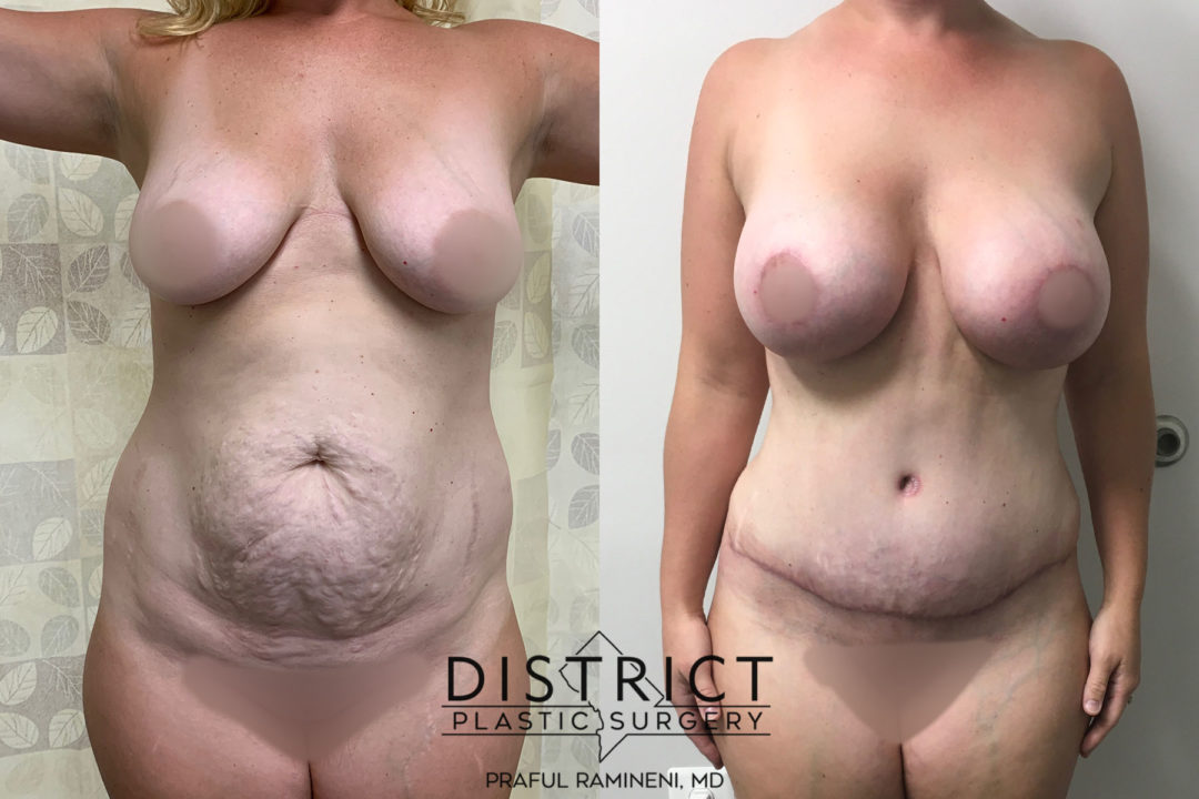 abdominoplasty before and after