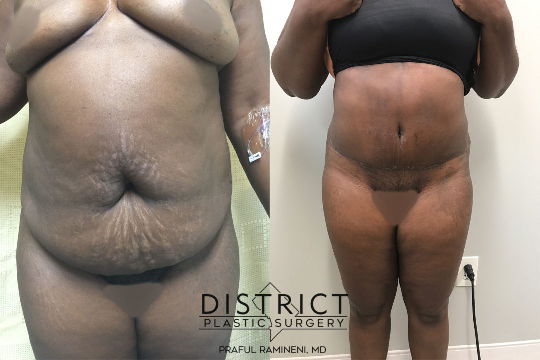 abdominoplasty before and after