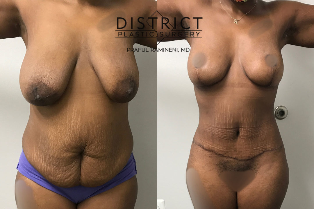 mommy makeover before and after