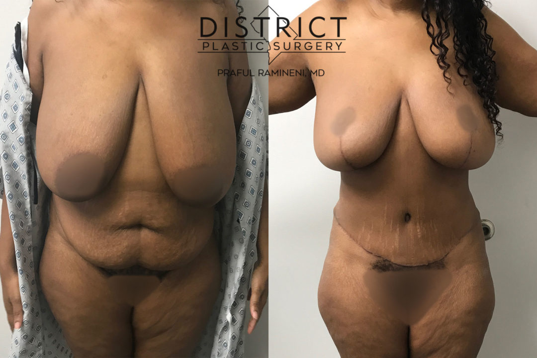 mommy makeover before and after