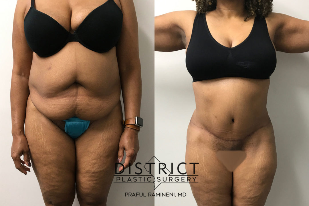abdominoplasty before and after