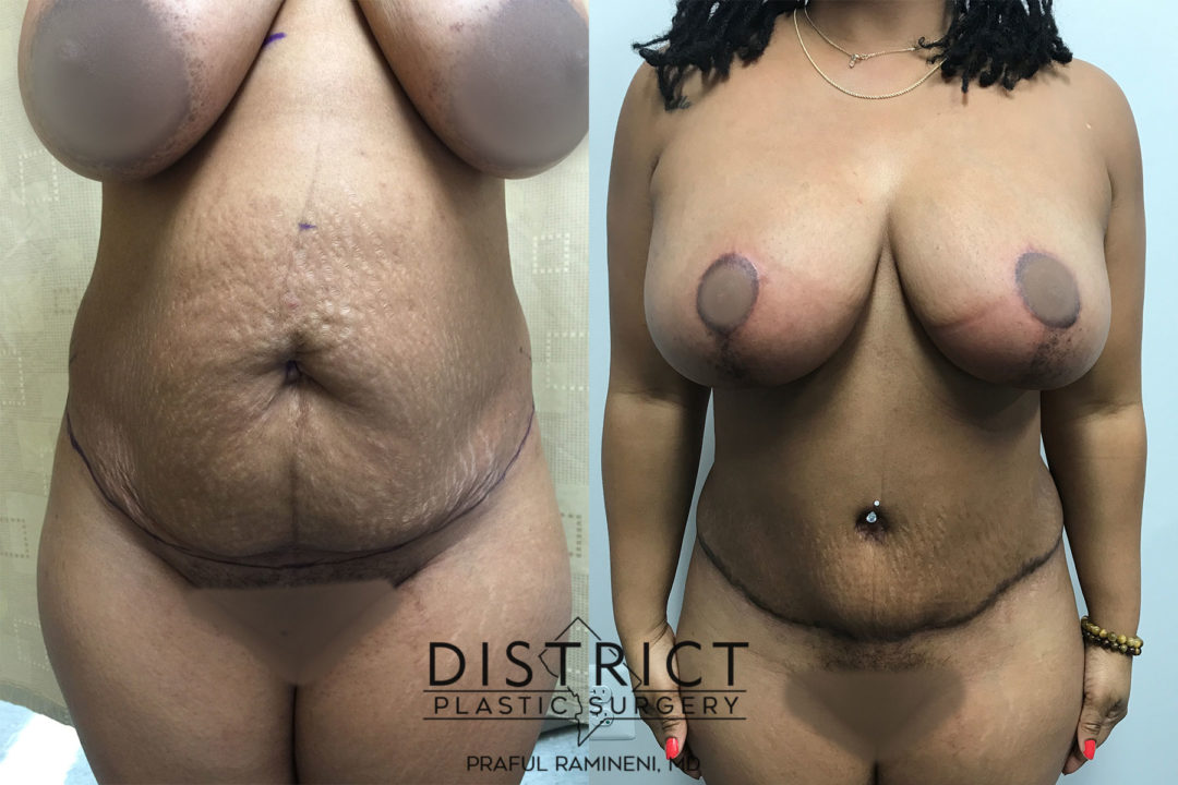 mommy makeover before and after