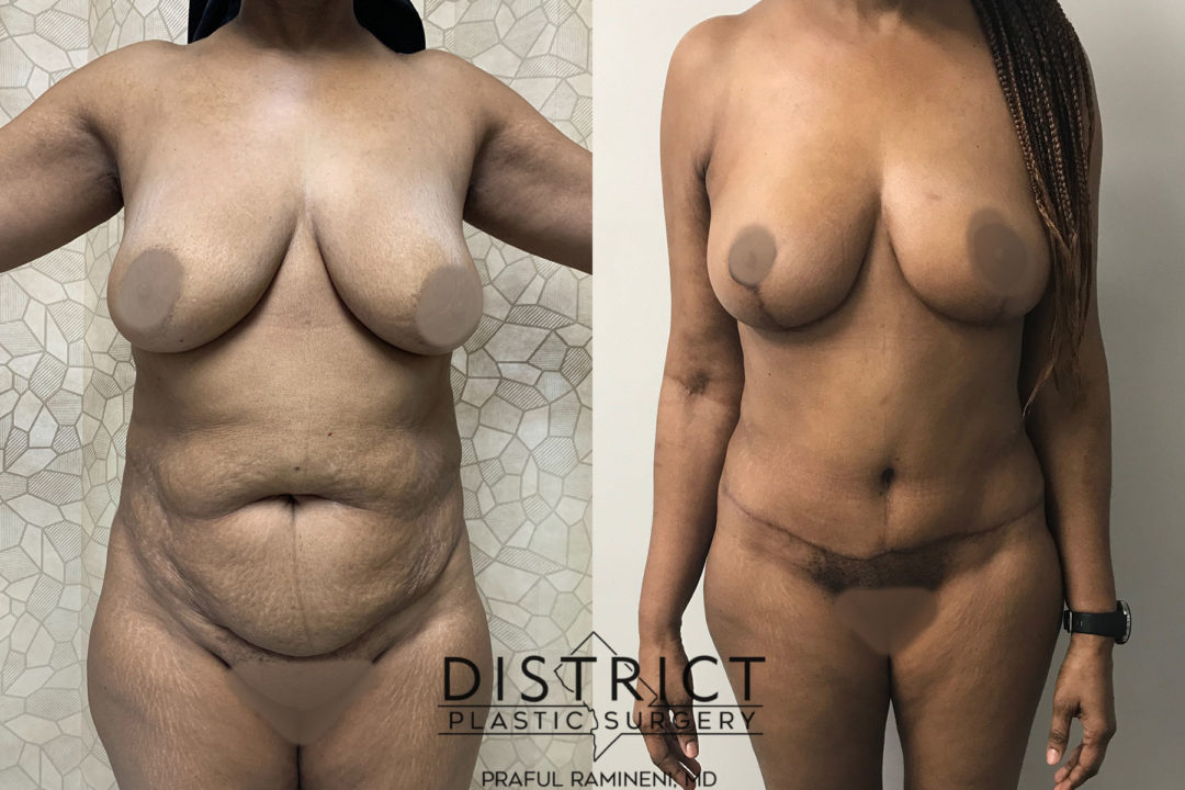 abdominoplasty before and after