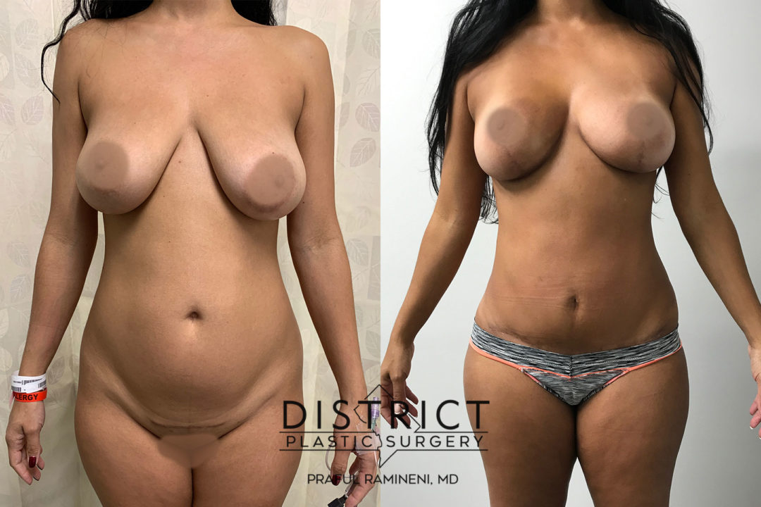 mommy makeover before and after