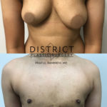 double incision mastectomy before and after
