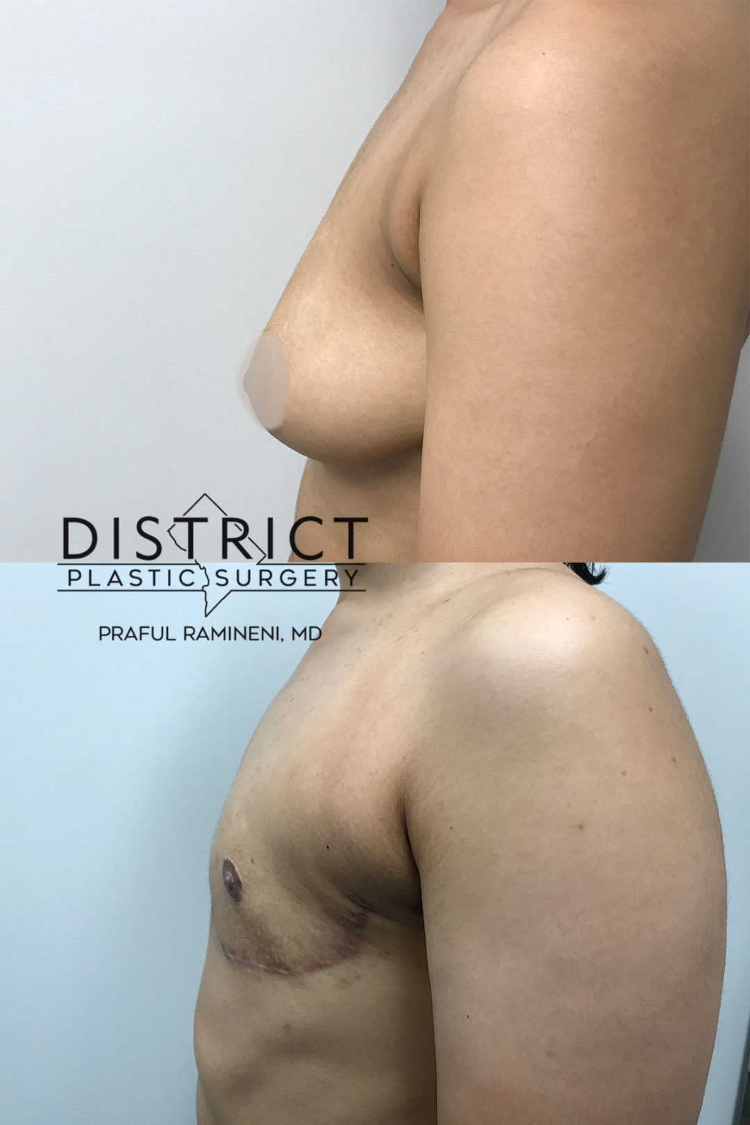 double incision mastectomy before and after
