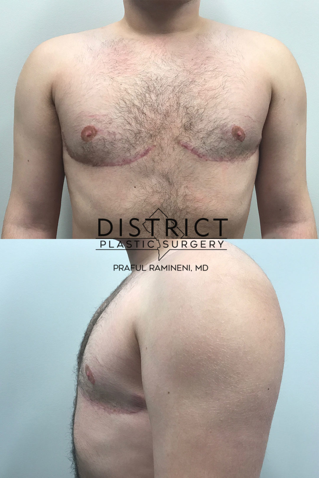 double incision mastectomy before and after