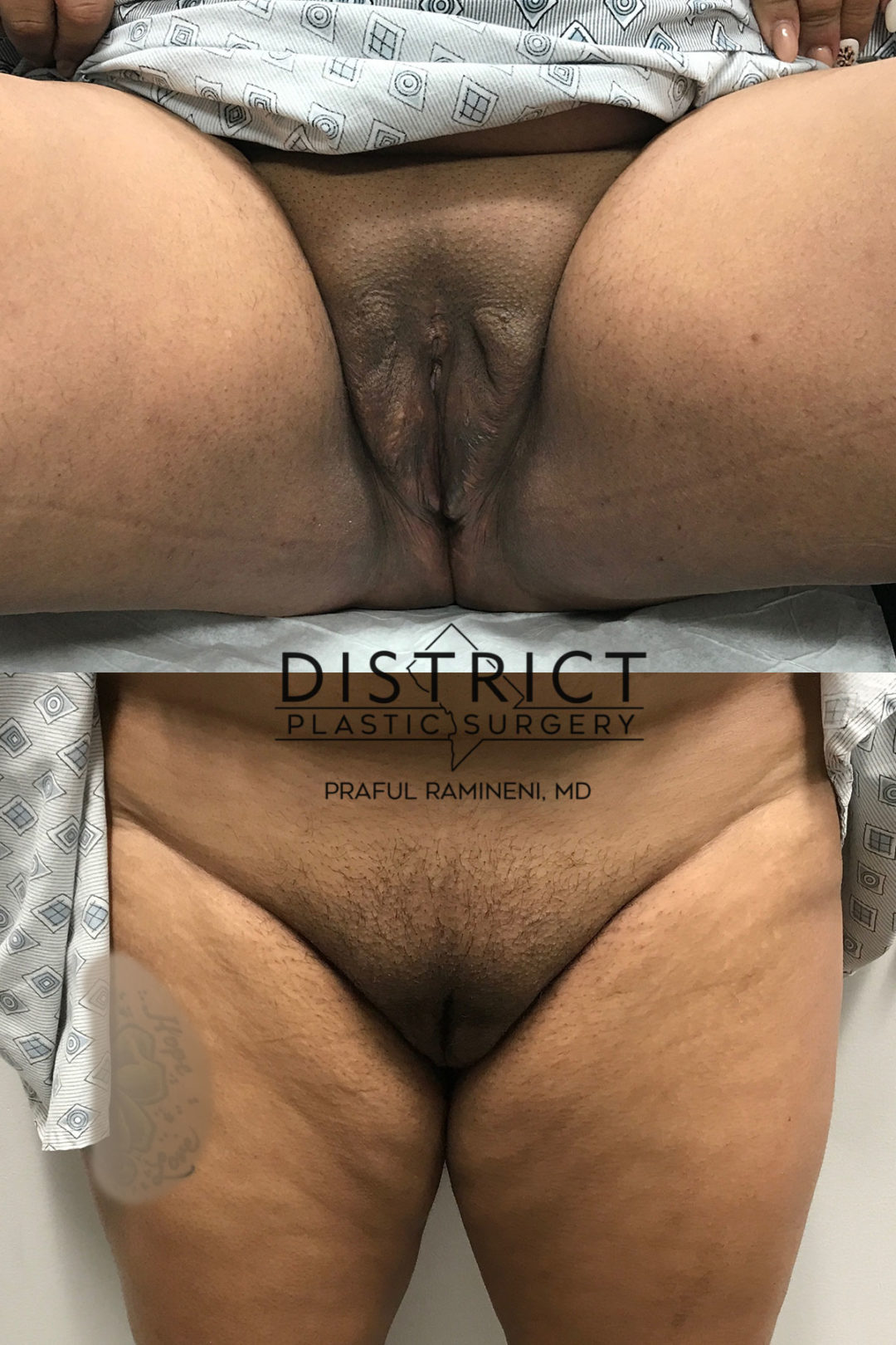 vaginoplasty before and after