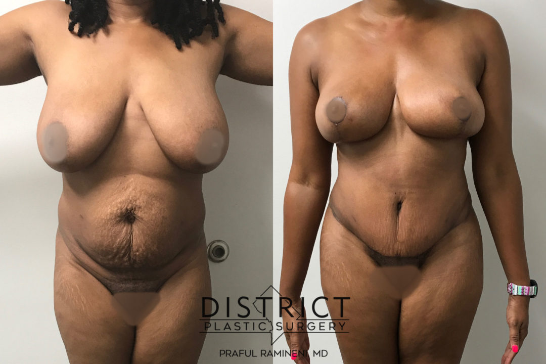 mommy makeover before and after