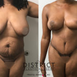 mommy makeover before and after