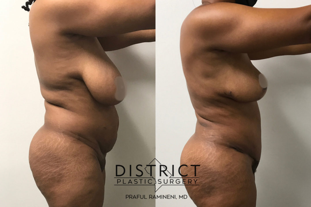 mommy makeover before and after