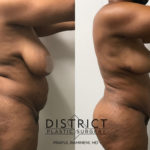 mommy makeover before and after
