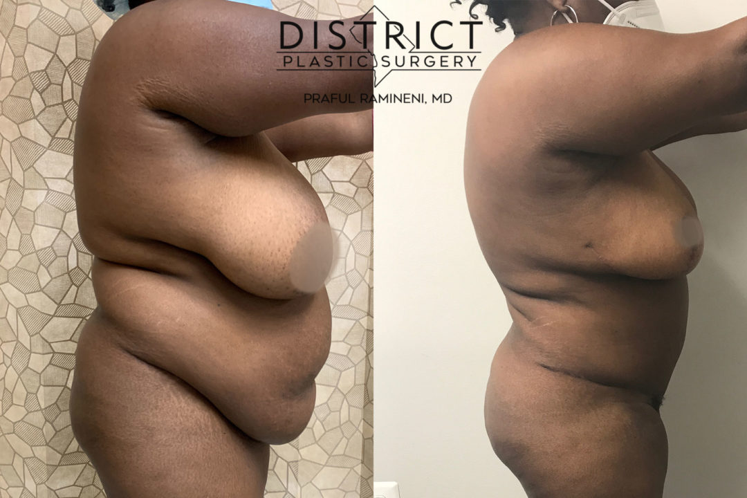 mommy makeover before and after