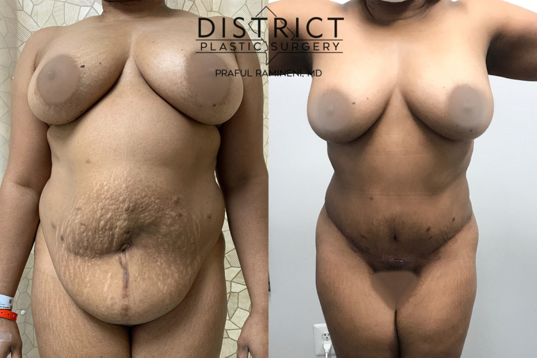 abdominoplasty before and after